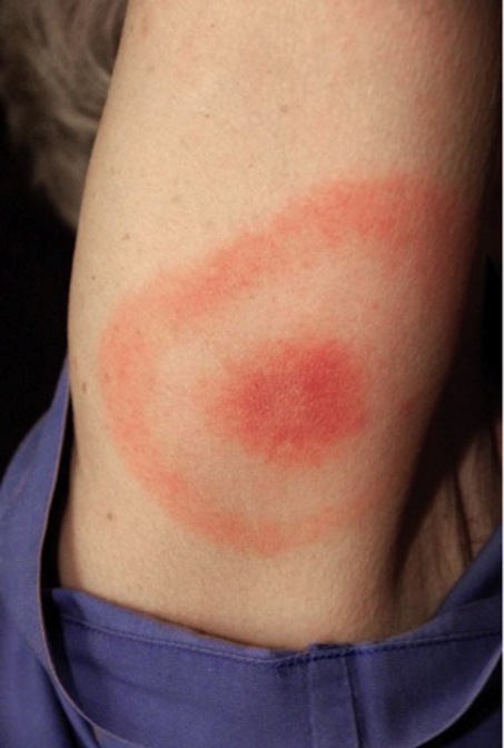 CDC Bulls Eye Rash